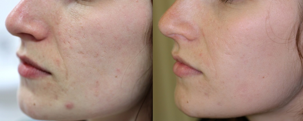 acne vulgaris pictures